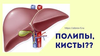 Полипы и кисты. Как удалить полип, кисту без операции. #здоровье