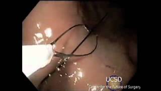 TOTAL ENDOSCOPIC GASTRIC BAND REMOVAL: Kari Thompson, MD