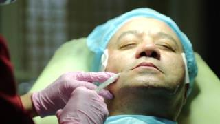 Видео - тредлифтинг 2 L FACELIFT AGAROSE GEL AND THREADLIFT