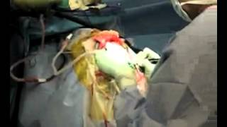 Dr. Isaac Yang performs brain surgery