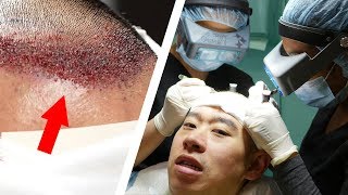 A Bald Man Tries Hair Transplant Surgery