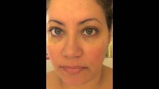 Day #5 TOTAL ABDOMINAL hysterectomy
