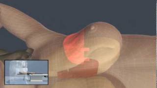 Breast Cancer Treatment