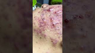 Mụn bé thành 17t má trái nặng nhất đã đang dần ổn part13(spa Hải Âu)
