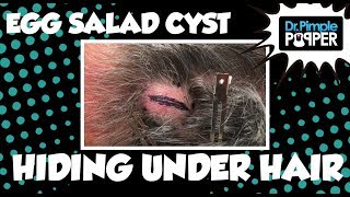 Egg Salad Cyst Bigger Than Expected