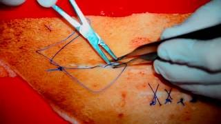 Cosmetic skin suture #2 Шов Холстеда (косметический шов), выпуск 16. 1080р!