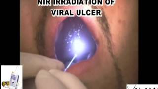 Viralulcertitle wmv