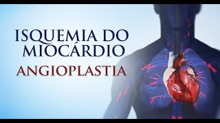 Isquemia do Miocárdio