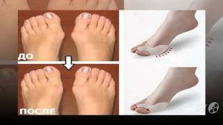 тренажер для косточки на ноге

  - valgus pro применение