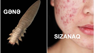 Gənə və ya demodex folliculorum paraziti sızanağa (Akne) səbəb olmur.