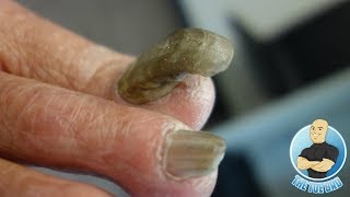 RAM'S HORN 4 YEARS WITHOUT BEING CUT!!!  EXTREME TOENAIL CUTTING OF A THICK NAIL