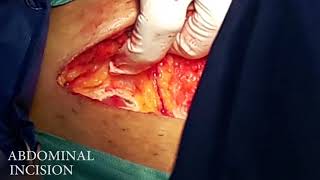 SIMPLE TOTAL ABDOMINAL HYSTERECTOMY WITH BILATERAL SALPINGO OOPHORECTOMEY
