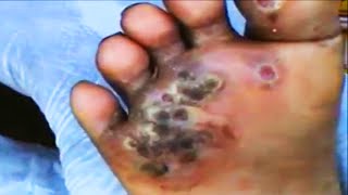 Big Jiggers Removed by Rise Up Society (Part One)