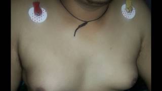 Male Breast Reduction Surgery, Subcutaneous mastectomy for Gaynaecomastia - Dr Narotam Dewan