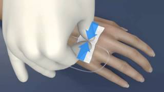 3M™ Tegaderm™ I.V. Advanced Securement Dressing - 1683 | Application and Removal