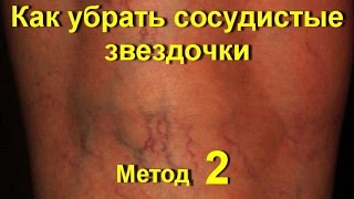 Варикоз.Лечение сосудов.Сосудистые звездочки на ногах! Как избавиться от сосудистых сеточек № 2