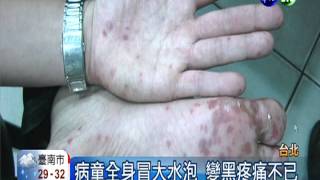腸病毒變種升溫 水泡刺破易傳染