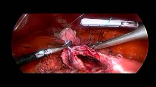 Mini Gastrik Bypass (Laparoskopik Mini Gastrik Bypass)