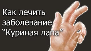 Как лечить заболевание "Куриная лапа"