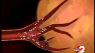 Liver tumor treatment