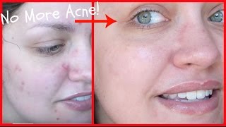My Skin Story: How I Cleared Up My Acne + Daily AM & PM Routine!