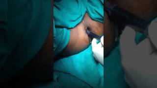 FISTULA IN ANO COMMUNICATING