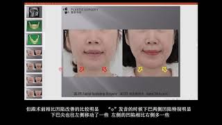 下巴手术 [H整形医院]  韩国整形医院