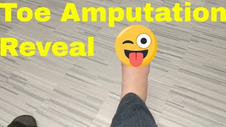 Doctor Visit & Amputation Reveal