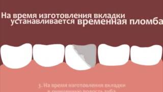 Протезирование зубов вкладками orange