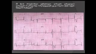 ჰიპერტროფიული კარდიომიოპათია (ექოკ: პარკუჭთაშუა ძგიდის ასიმეტრიული ჰიპერტროფია, ვენტურის ეფექტი)