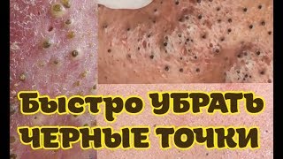 Самый ДЕШЕВЫЙ СПОСОБ удаления ЧЕРНЫХ ТОЧЕК! МОЯ УЖАСНАЯ КОЖА!