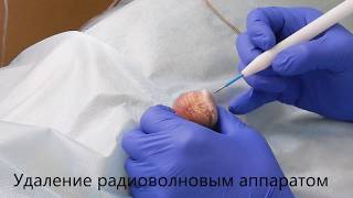 Удаление перламутровых папул - Уролог Смерницкий