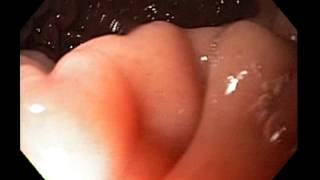 Upper GI endoscopy
