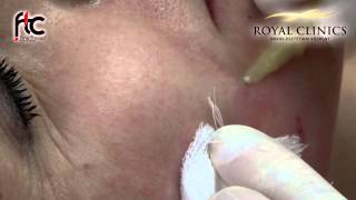 Pataki Zita - Fine Thread Contour Therapy (Thread Lifting) - Royal Clinics