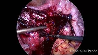 Tricky case of severe endometriosis and multiple myoma management.