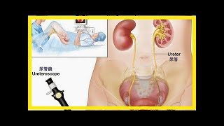 小便3個表現可檢測前列腺炎