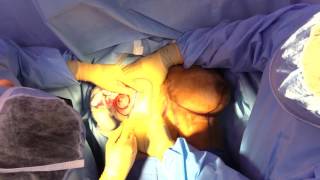Breast Lift With Implants - Step By Step
