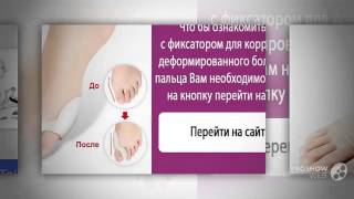 проблема косточки на ногах

  - Valgus Pro - Обзор Фиксатора