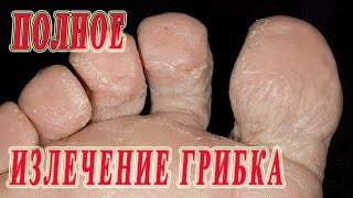 ★Полное ИЗЛЕЧЕНИЕ ГРИБКА между пальцами ног. Препараты и народные средства.