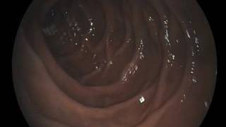 Gastroscopy