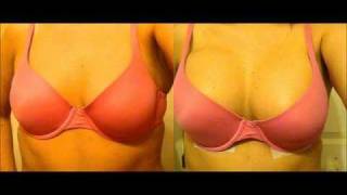 Before and After Plastic Surgery