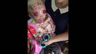 Harlequin ichthyosis kid china