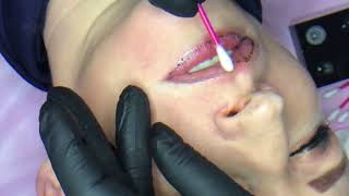 Tattoo Remover