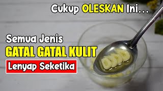 RESEP PATEN! KADAS KURAP DAN BERBAGAI JENIS GATAL-GATAL LAINNYA SEMBUH TOTAL 