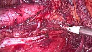 Extra-peritoneal approach laparoscopic para-aortic lymphadenectomy in Gynaecological Cancers