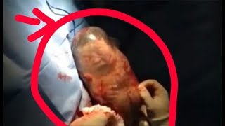 Live birthing of triplet's silicone babies in the womb