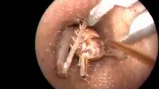 Tickly ear - Big Bug removed from a Ear!!