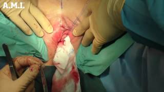 sensiTVT-A Adjustable Urinary Sling