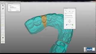 Integrazione Sum3D Dental in Exocad