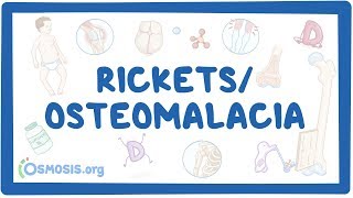 Rickets/osteomalacia - causes, symptoms, diagnosis, treatment, pathology